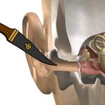 10 Tips Menyembuhkan Telinga Tertusuk dengan Langkah Tepat