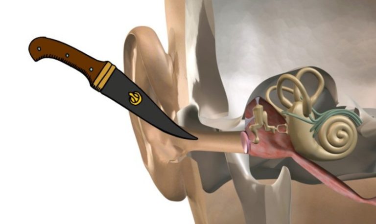 10 Tips Menyembuhkan Telinga Tertusuk dengan Langkah Tepat