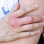 7 Tips Mengatasi Pembengkakan pada Sendi secara Efektif
