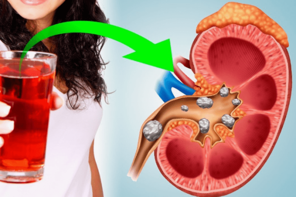 7 Minuman yang Menyehatkan Ginjal Anda Setiap Hari