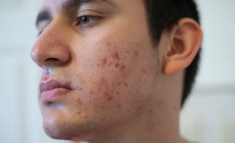 10 Kebiasaan Sehat agar Dagu Tidak Mudah Berjerawat