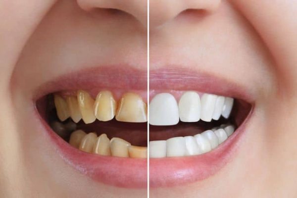 7 Cara Alami Memutihkan Gigi Tanpa Bahan Kimia 7 Cara Alami Memutihkan Gigi Tanpa Bahan Kimia