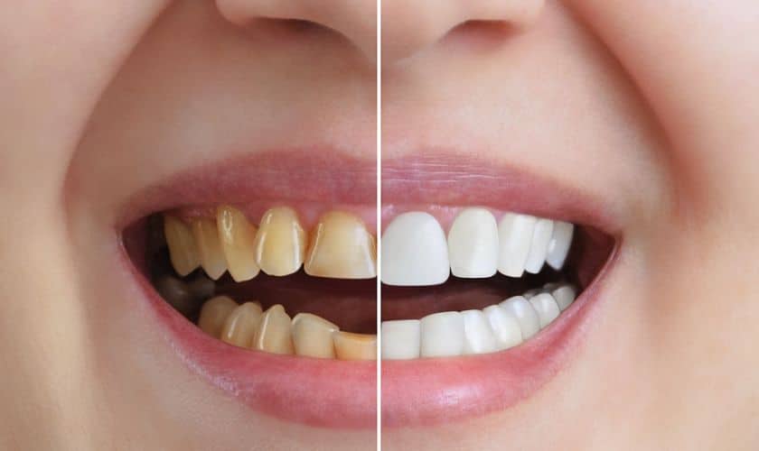 7 Cara Alami Memutihkan Gigi Tanpa Bahan Kimia