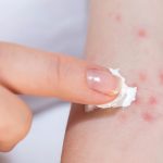 5 Bahan Alami yang Bisa Meredakan Alergi Kulit