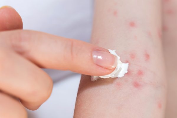 5 Bahan Alami yang Bisa Meredakan Alergi Kulit
