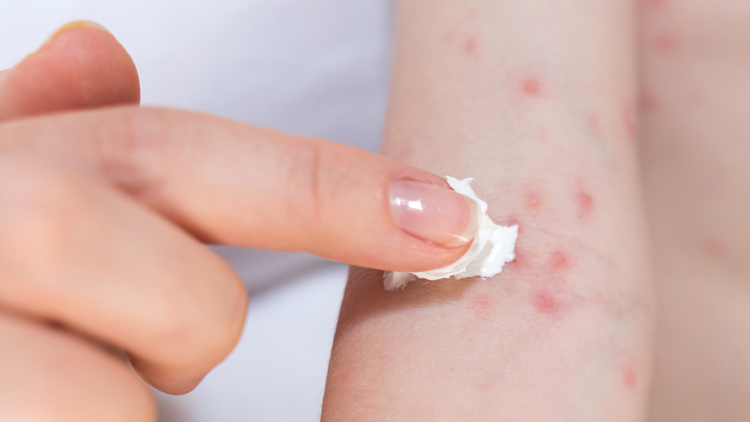 5 Bahan Alami yang Bisa Meredakan Alergi Kulit