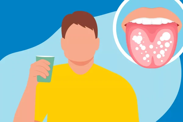 5 Tips Mengatasi Lidah Putih Secara Alami