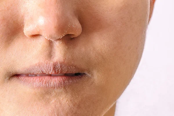 10 Cara Efektif Mengatasi Hidung Kering dan Perih