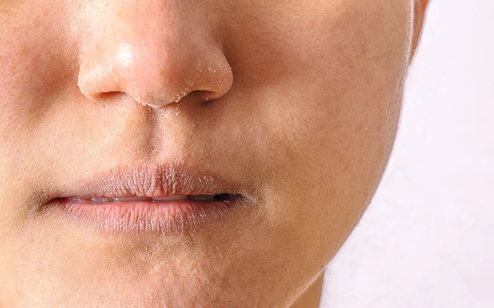 10 Cara Efektif Mengatasi Hidung Kering dan Perih