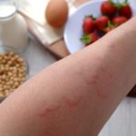 10 Tanda Alergi Makanan yang Sering Terabaikan