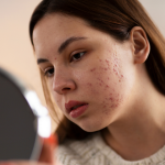 5 Tips Mengatasi Jerawat Saat Menstruasi